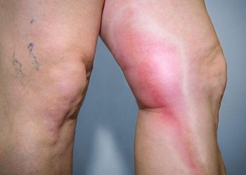 Know more about Vein Specialist