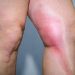 Know more about Vein Specialist