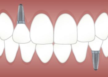 Why should you look for a dental implant?