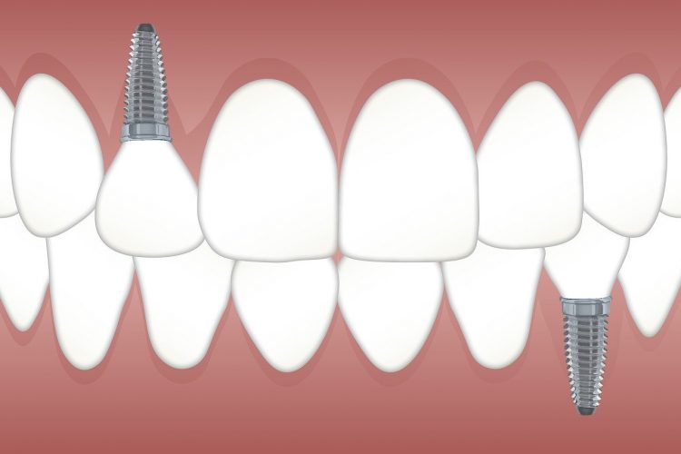 Why should you look for a dental implant?