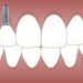 Why should you look for a dental implant?